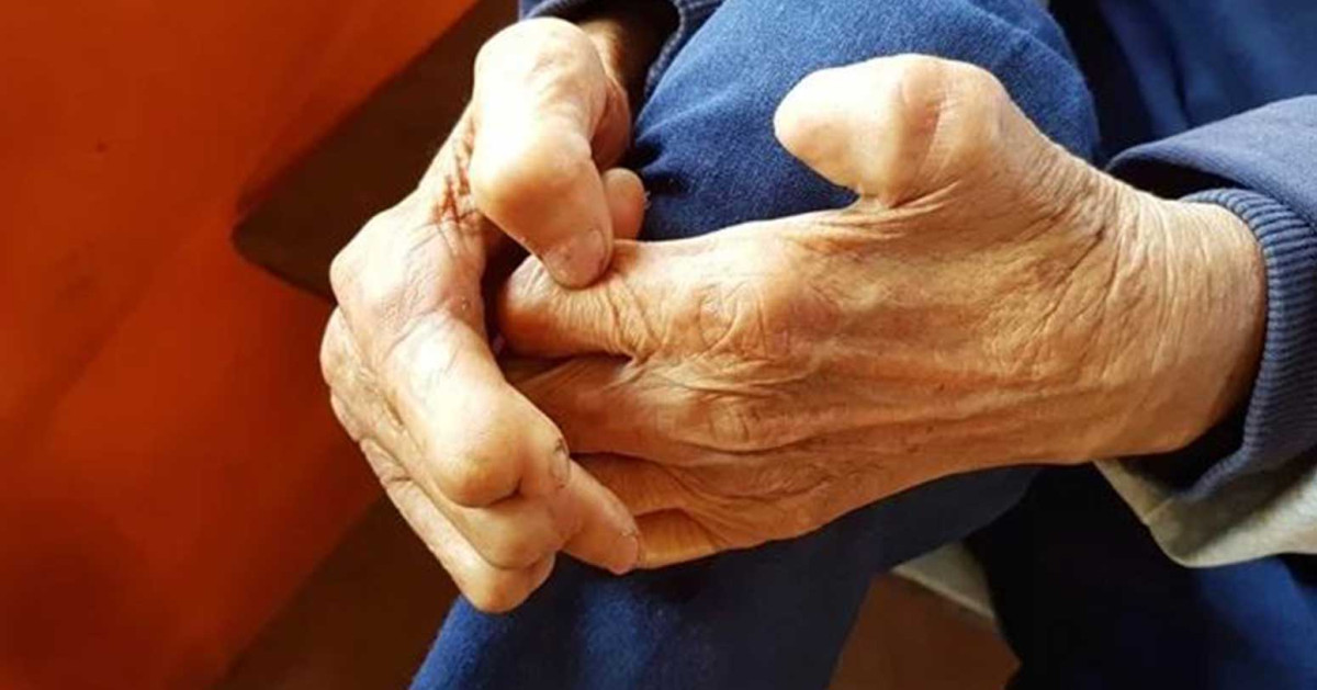 बाँकेमा एक सय ४६ जनामा कुष्ठरोग